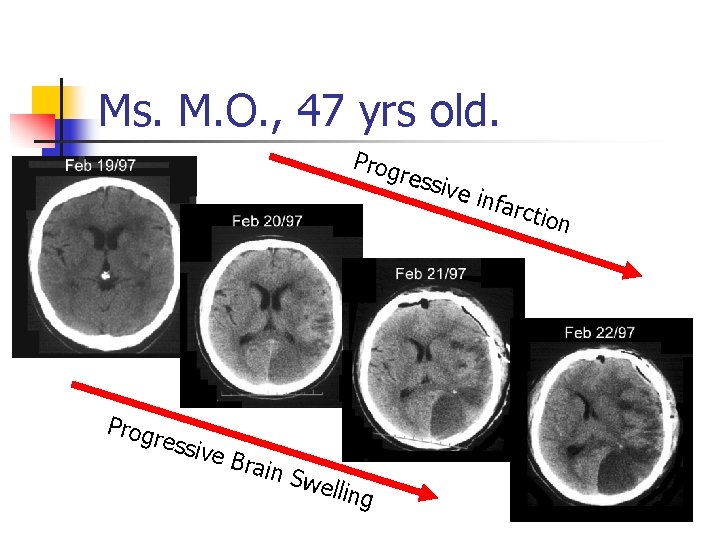 Ms. M. O. , 47 yrs old. Prog ressi ve B rain Swe lling