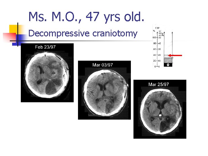 Ms. M. O. , 47 yrs old. Decompressive craniotomy 