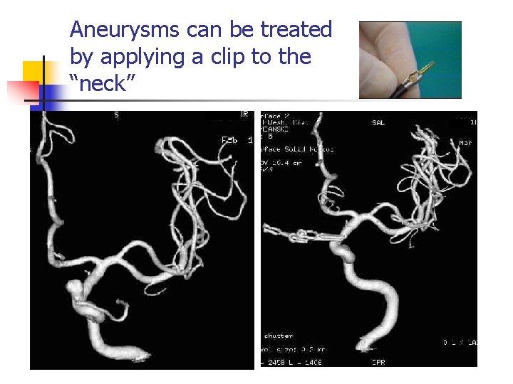 Aneurysms can be treated by applying a clip to the “neck” 