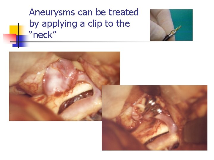 Aneurysms can be treated by applying a clip to the “neck” 