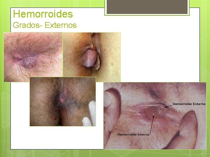 Hemorroides Grados- Externos 
