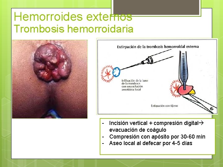 Hemorroides externos Trombosis hemorroidaria - Incisión vertical + compresión digital evacuación de coágulo -