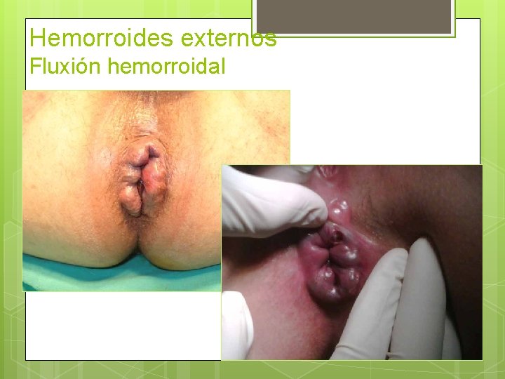 Hemorroides externos Fluxión hemorroidal 