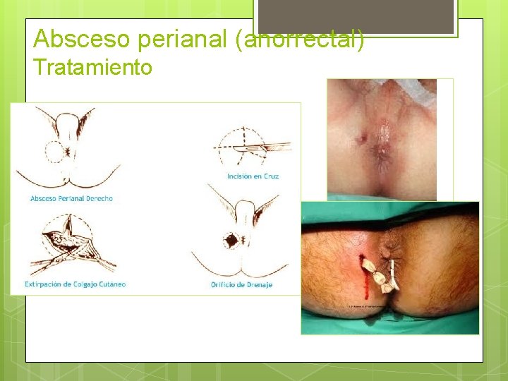 Absceso perianal (anorrectal) Tratamiento 