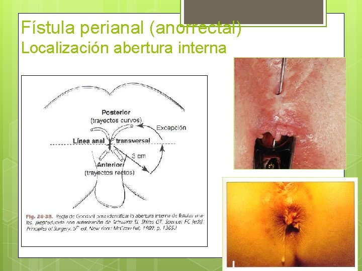 Fístula perianal (anorrectal) Localización abertura interna 