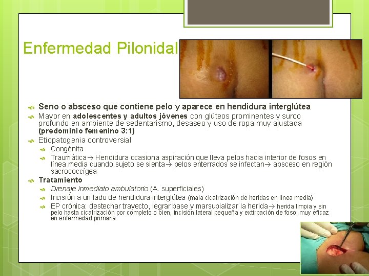 Enfermedad Pilonidal Sacrococcígea Seno o absceso que contiene pelo y aparece en hendidura interglútea