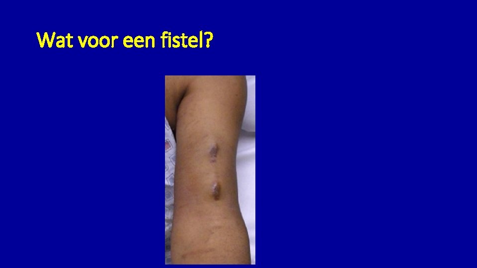 Wat voor een fistel? 