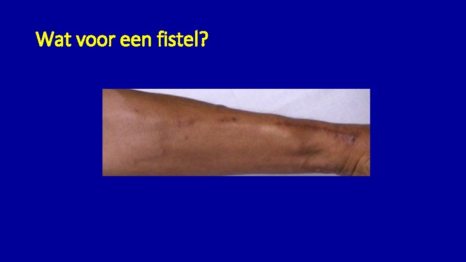 Wat voor een fistel? 