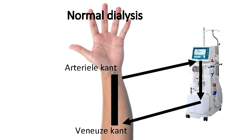 Normal dialysis Arteriele kant Veneuze kant 