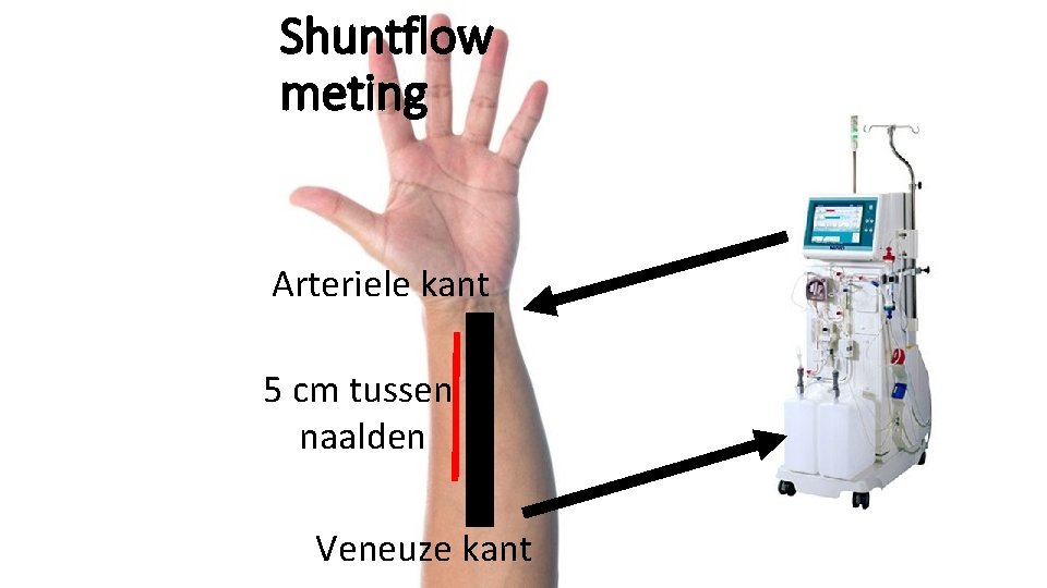 Shuntflow meting Arteriele kant 5 cm tussen naalden Veneuze kant 