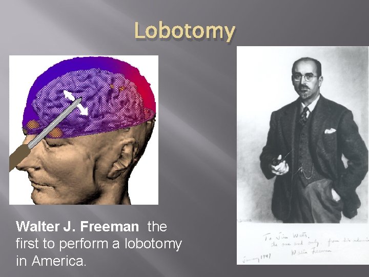 Lobotomy Walter J. Freeman the first to perform a lobotomy in America. 