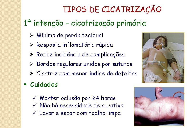 TIPOS DE CICATRIZAÇÃO 1ª intenção – cicatrização primária Ø Mínimo de perda tecidual Ø