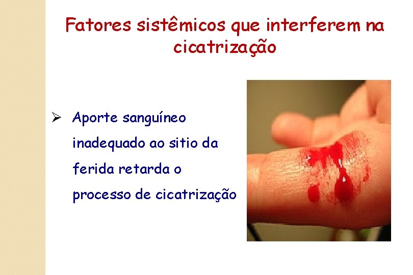 Fatores sistêmicos que interferem na cicatrização Ø Aporte sanguíneo inadequado ao sitio da ferida