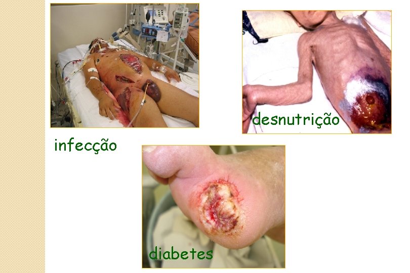 desnutrição infecção diabetes 