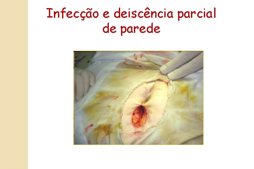 Infecção e deiscência parcial de parede 