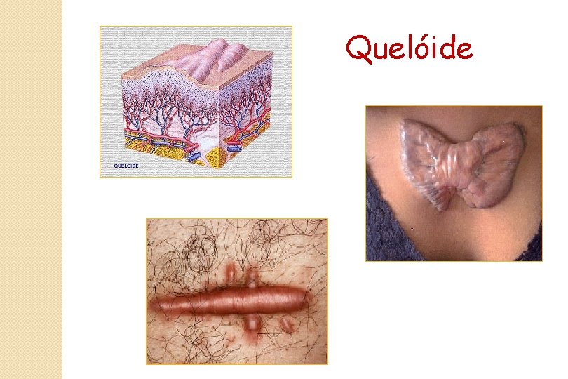 Quelóide 