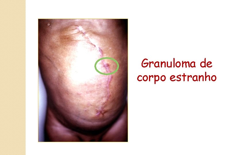 Granuloma de corpo estranho 