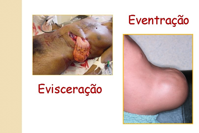 Eventração Evisceração 