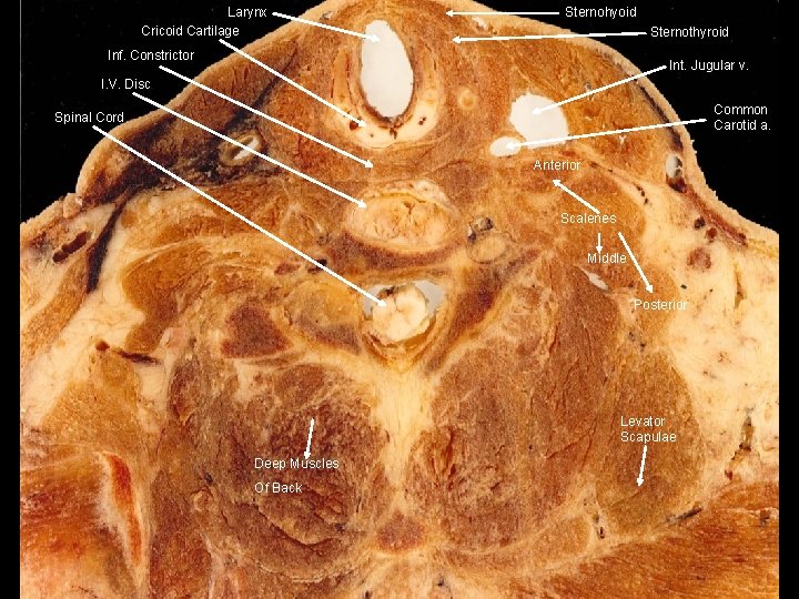 Larynx Cricoid Cartilage Sternohyoid Sternothyroid Inf. Constrictor Int. Jugular v. I. V. Disc Common