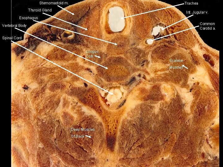 Sternomastoid m. Trachea Thyroid Gland Int. Jugular v. Esophagus Common Carotid a. Vertebral Body