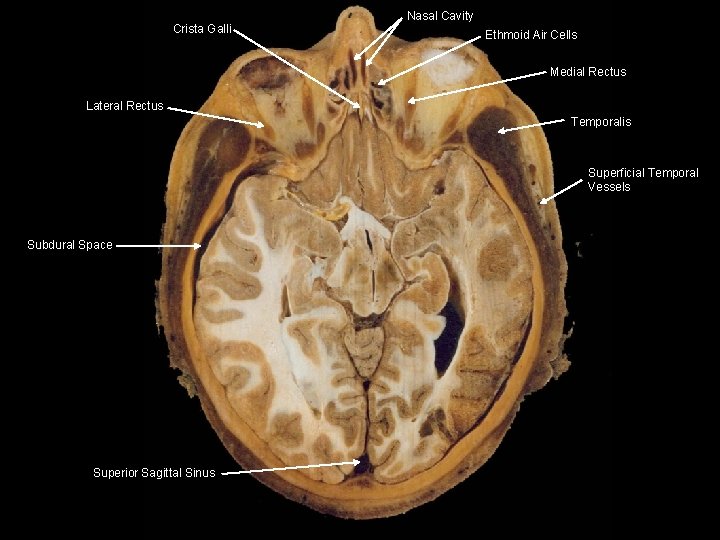 Nasal Cavity Crista Galli Ethmoid Air Cells Medial Rectus Lateral Rectus Temporalis Superficial Temporal