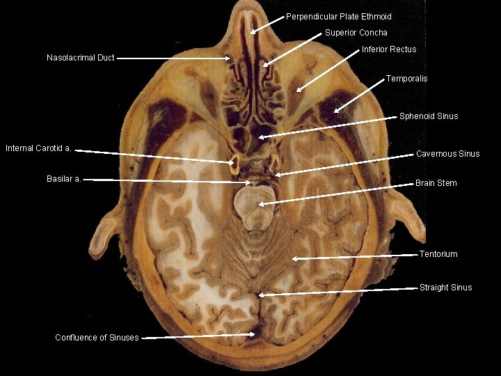 Perpendicular Plate Ethmoid Superior Concha Nasolacrimal Duct Inferior Rectus Temporalis Sphenoid Sinus Internal Carotid