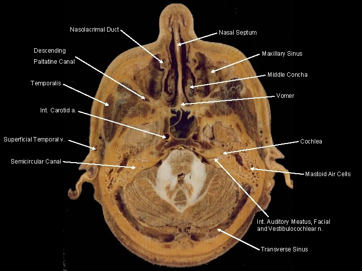 Nasolacrimal Duct Descending Nasal Septum Maxillary Sinus Paltatine Canal Middle Concha Temporalis Vomer Int.