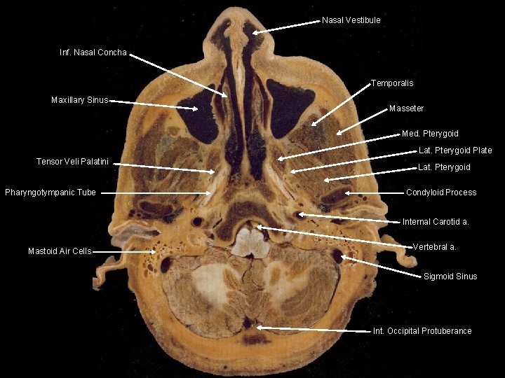 Nasal Vestibule Inf. Nasal Concha Temporalis Maxillary Sinus Masseter Med. Pterygoid Lat. Pterygoid Plate