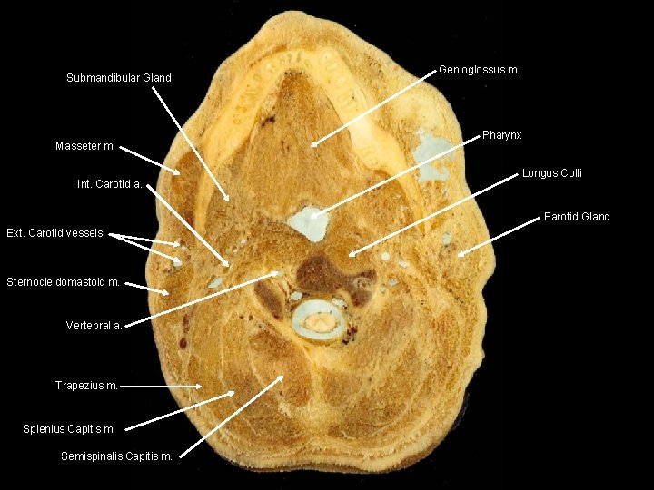 Submandibular Gland Masseter m. Int. Carotid a. Genioglossus m. Pharynx Longus Colli Parotid Gland