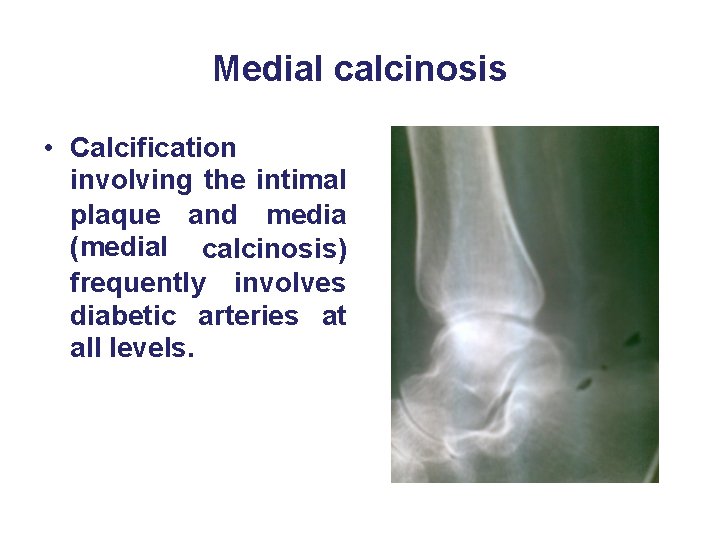Medial calcinosis • Calcification involving the intimal plaque and media (medial calcinosis) frequently involves Medial calcinosis • Calcification involving the intimal plaque and media (medial calcinosis) frequently involves