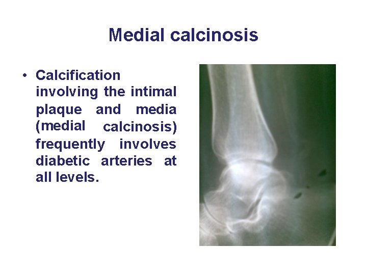 Medial calcinosis • Calcification involving the intimal plaque and media (medial calcinosis) frequently involves