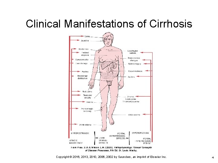 Clinical Manifestations of Cirrhosis From Price, S. A. & Wilson, L. M. (2003). Pathophysiology: