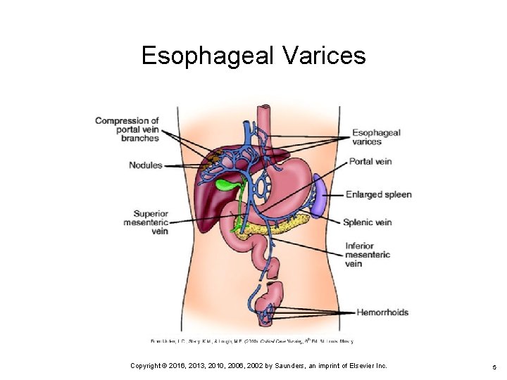 Esophageal Varices 5 Copyright © 2016, 2013, 2010, 2006, 2002 by Saunders, an imprint