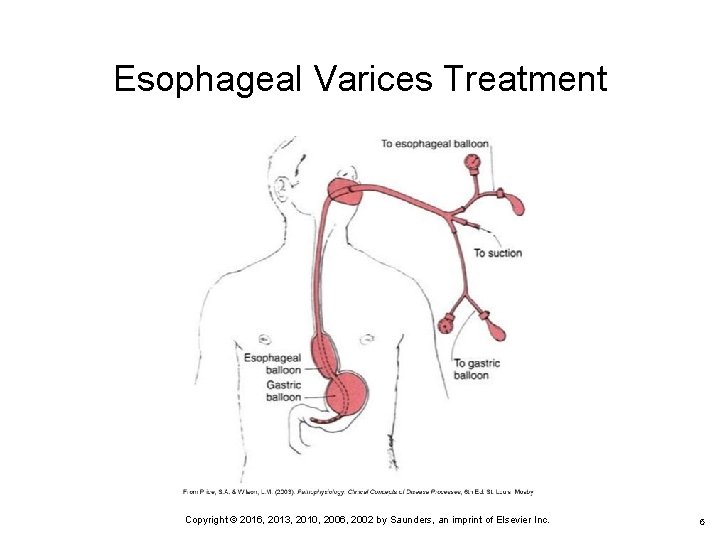 Esophageal Varices Treatment 6 Copyright © 2016, 2013, 2010, 2006, 2002 by Saunders, an