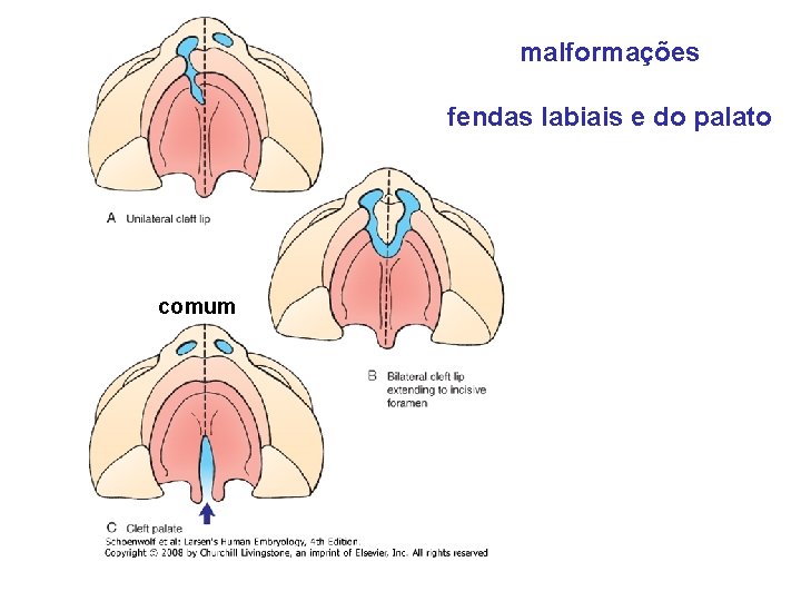 malformações fendas labiais e do palato comum 