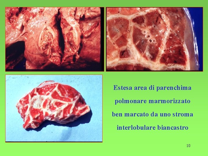 Estesa area di parenchima polmonare marmorizzato ben marcato da uno stroma interlobulare biancastro 10