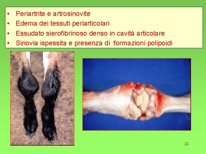  • • Periartrite e artrosinovite Edema dei tessuti periarticolari Essudato sierofibrinoso denso in