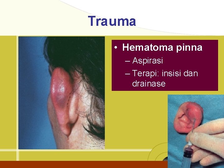 Trauma • Hematoma pinna – Aspirasi – Terapi: insisi dan drainase 