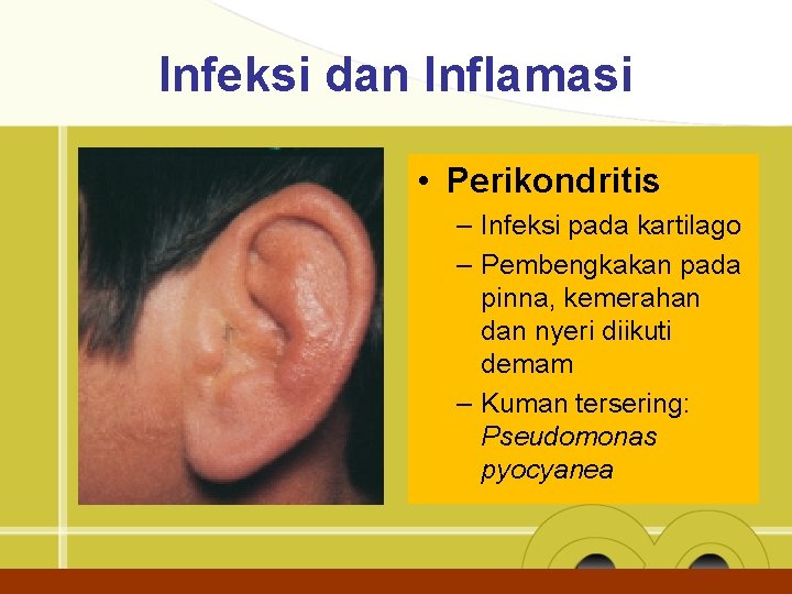 Infeksi dan Inflamasi • Perikondritis – Infeksi pada kartilago – Pembengkakan pada pinna, kemerahan