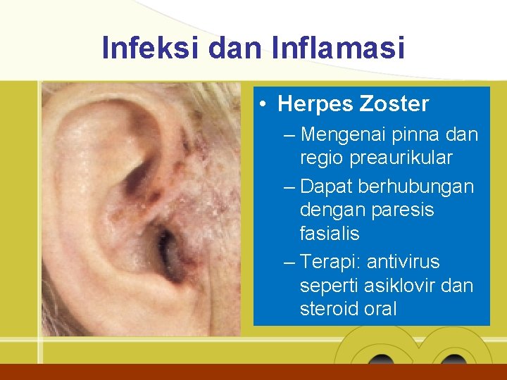 Infeksi dan Inflamasi • Herpes Zoster – Mengenai pinna dan regio preaurikular – Dapat