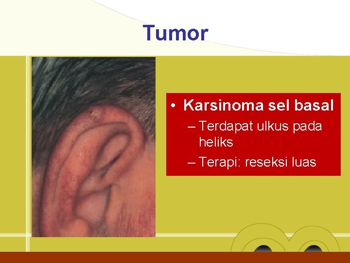 Tumor • Karsinoma sel basal – Terdapat ulkus pada heliks – Terapi: reseksi luas