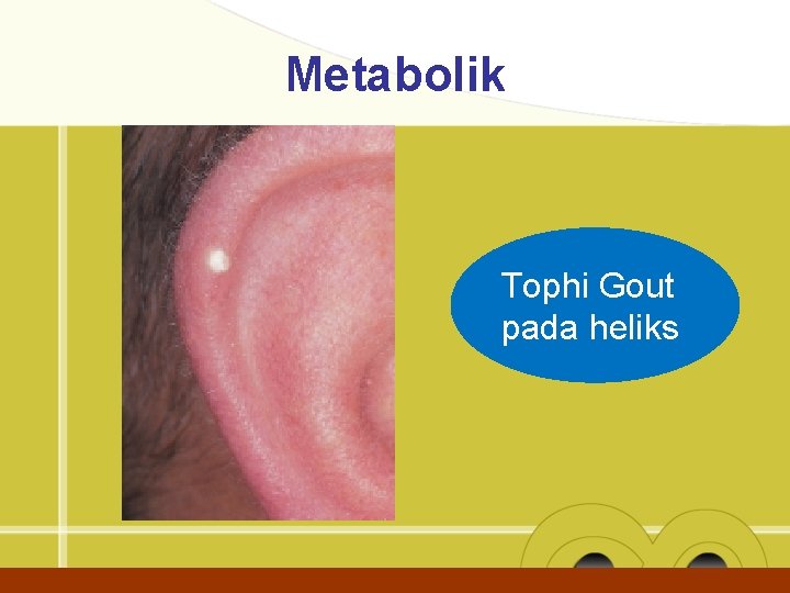 Metabolik Tophi Gout pada heliks 