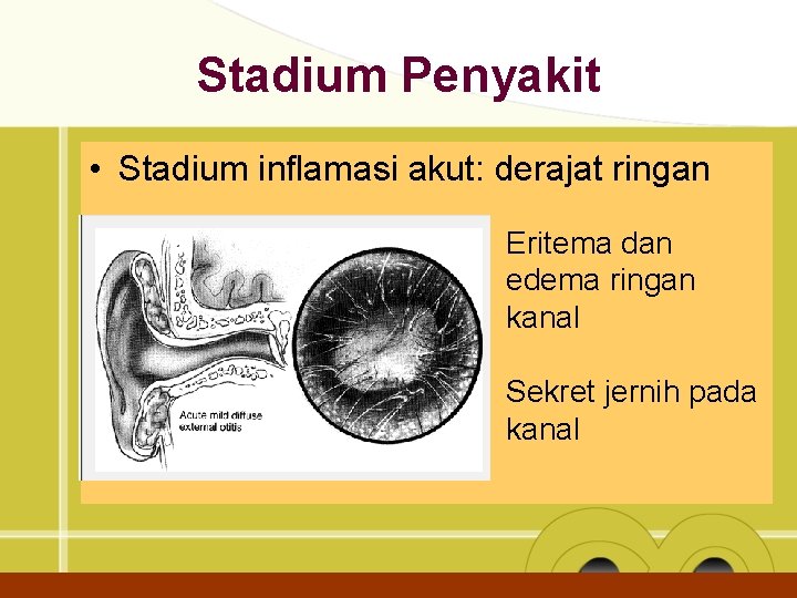 Stadium Penyakit • Stadium inflamasi akut: derajat ringan Eritema dan edema ringan kanal Sekret