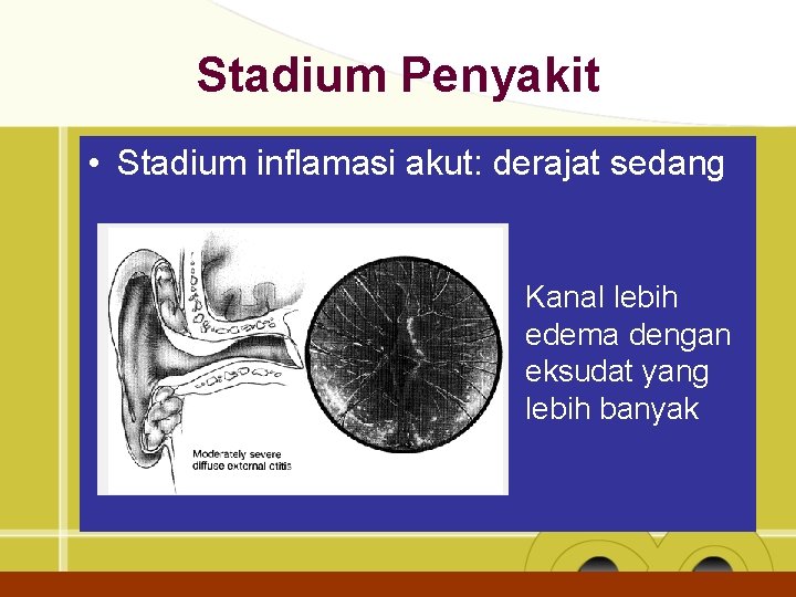 Stadium Penyakit • Stadium inflamasi akut: derajat sedang Kanal lebih edema dengan eksudat yang