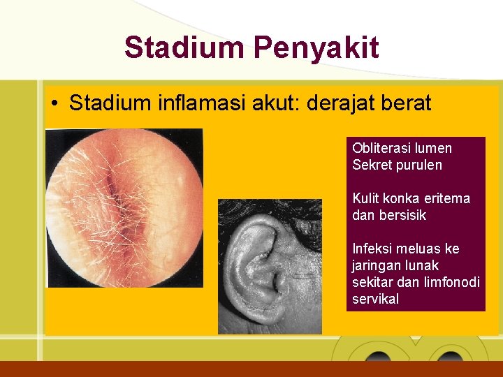 Stadium Penyakit • Stadium inflamasi akut: derajat berat Obliterasi lumen Sekret purulen Kulit konka