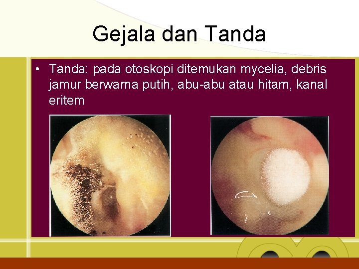 Gejala dan Tanda • Tanda: pada otoskopi ditemukan mycelia, debris jamur berwarna putih, abu-abu