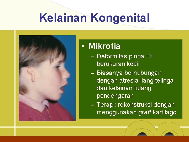 Kelainan Kongenital • Mikrotia – Deformitas pinna berukuran kecil – Biasanya berhubungan dengan atresia