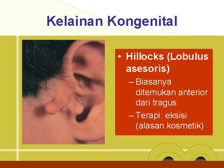 Kelainan Kongenital • Hillocks (Lobulus asesoris) – Biasanya ditemukan anterior dari tragus – Terapi: