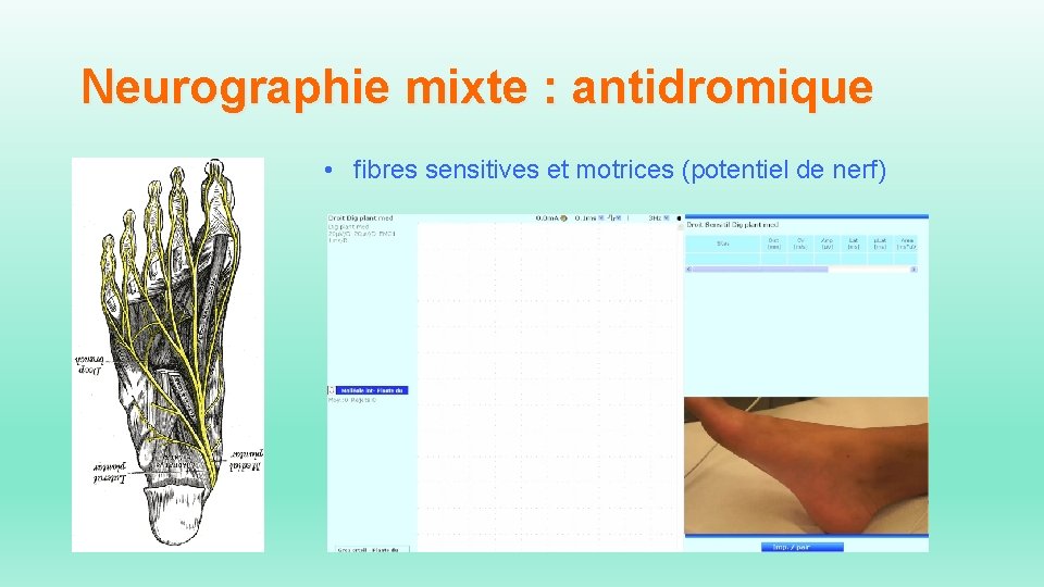 Neurographie mixte : antidromique • fibres sensitives et motrices (potentiel de nerf) 