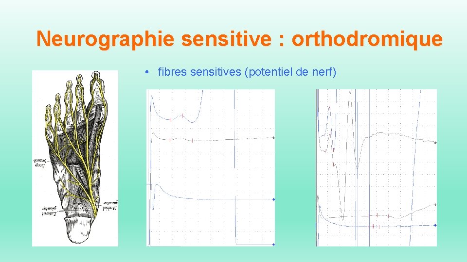 Neurographie sensitive : orthodromique • fibres sensitives (potentiel de nerf) 